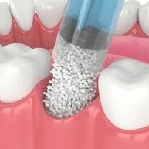 Bone Grafting for Dental Implants