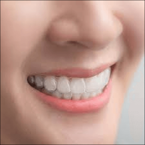 Clear Aligners