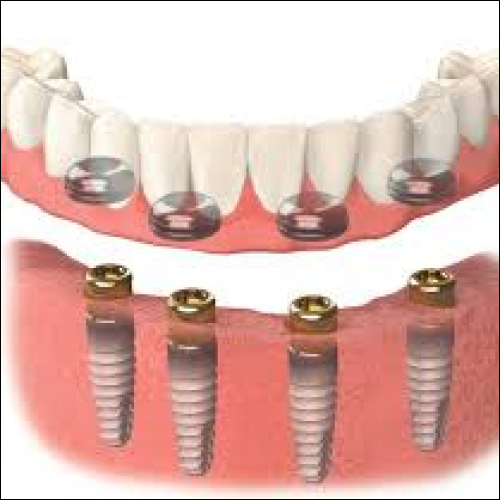 Dental Implant-Supported Dentures