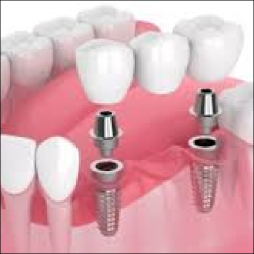 Implant Crowns & Bridges