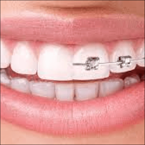 Invisalign vs. Metal Braces