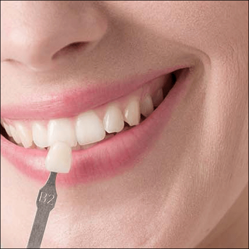 Porcelain Veneers