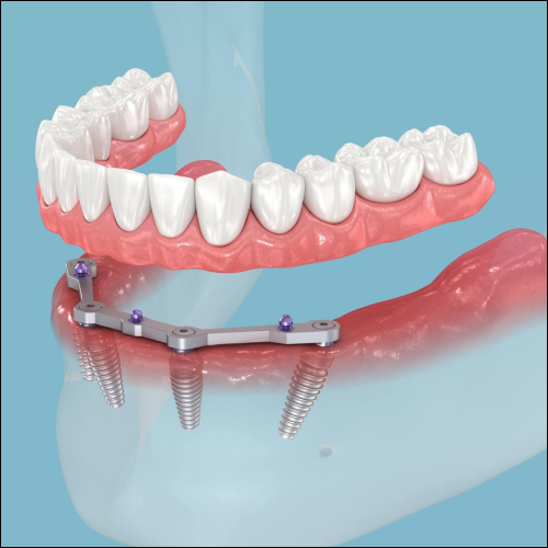 all-on-four dental implants