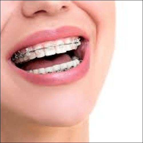 invisalign for crowded teeth