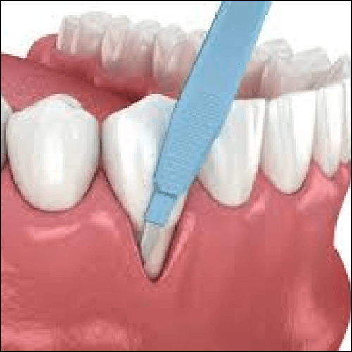 periodontal surgery