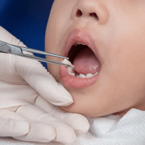 tooth extractions